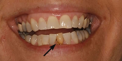 Cosmetic Tooth Restoration Before