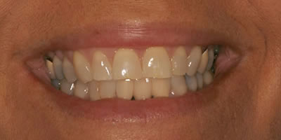 Cosmetic Tooth Restoration After