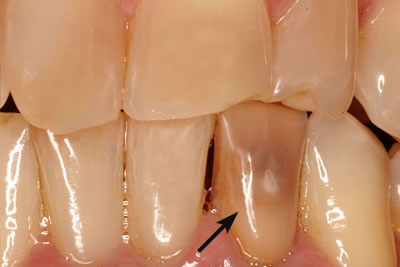 Knoxville Tooth Repair Before