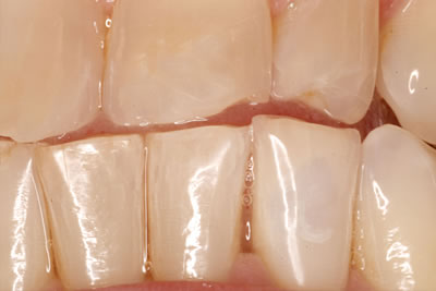 Knoxville Tooth Repair After
