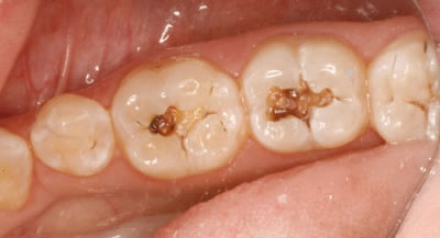 Composite Tooth Filling Before