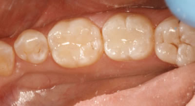 Composite Tooth Filling After