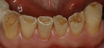 Bruxism Dental Restoration Before