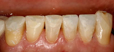 Bruxism Dental Restoration After
