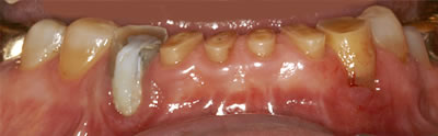 Dental Crowns Before