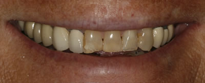 Knosville Cosmetic Dentist Before