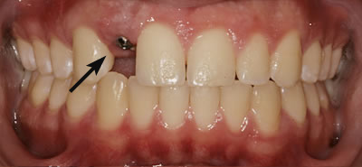 Knoxville Dental Implants Before