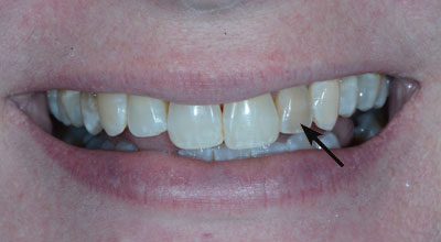 Cosmetic Dentist Before Photo