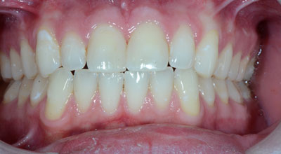 Cosmetic Dentist After Photo