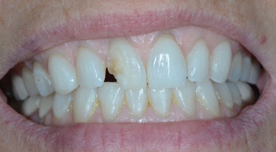 Chipped Tooth Repair Before Photo