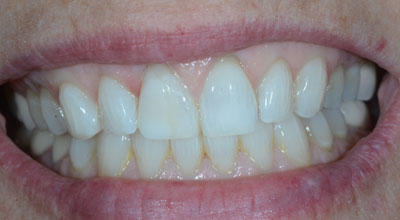 Chipped Tooth Repair After Photo